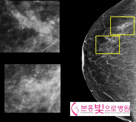 유방 엑스선촬영 (Mammography)
