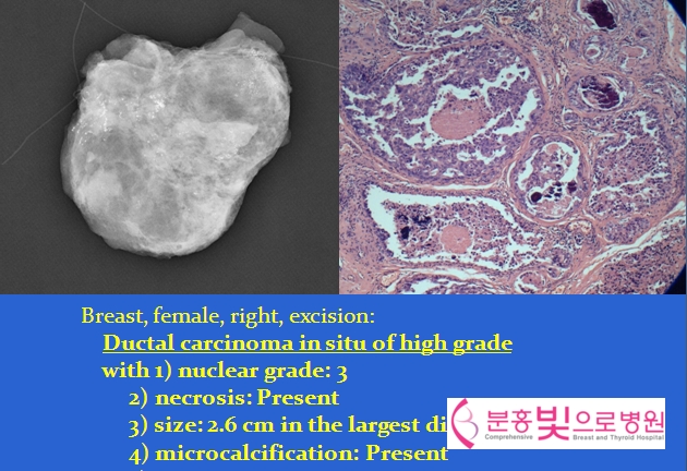 유방 엑스선촬영 (Mammography)