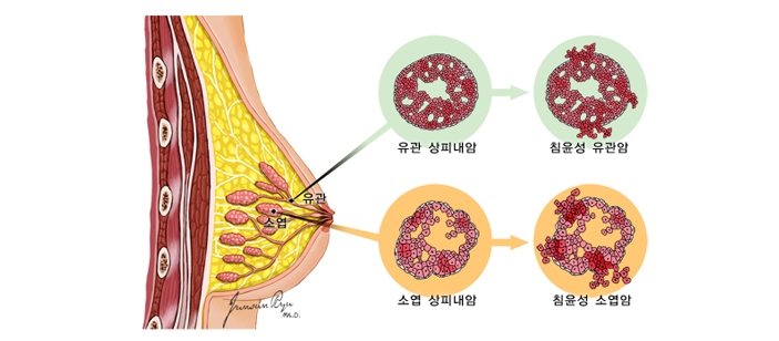 유방암이란