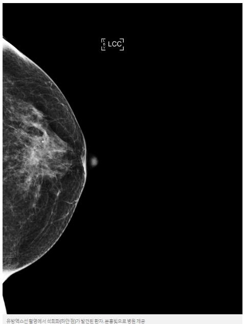 [건강플러스] 가슴 속 하얀 점…유방 석회화 세심한 검사 필요