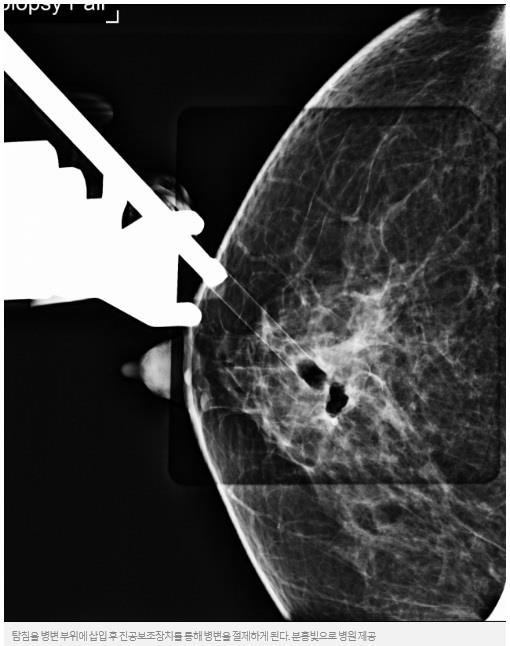 [건강플러스] 가슴 속 하얀 점…유방 석회화 세심한 검사 필요