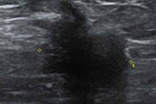 유방 초음파검사 (Ultrasonography)