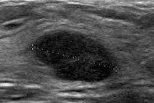 유방 초음파검사 (Ultrasonography)
